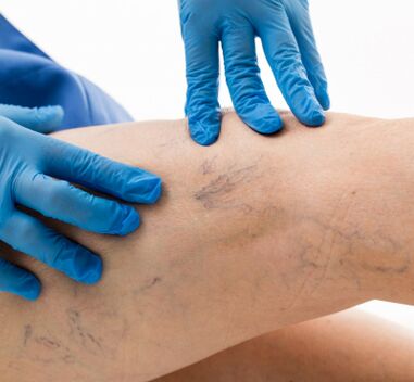 varices