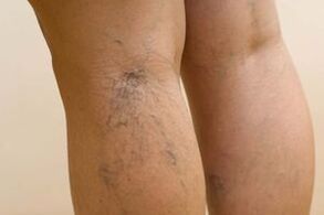 Comment les varices chez les femmes se manifestent