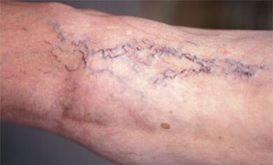 méthodes pour traiter les varices dans les jambes