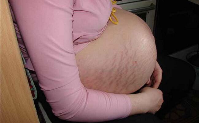 Causes des varices pendant la grossesse.