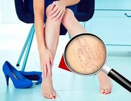 Les symptômes dépendent de la nature et du stade des varices.