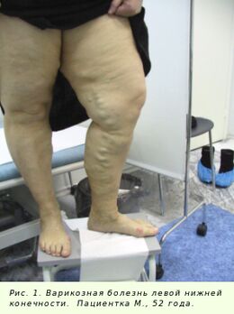 Les varices doivent être traitées pour arrêter le processus.