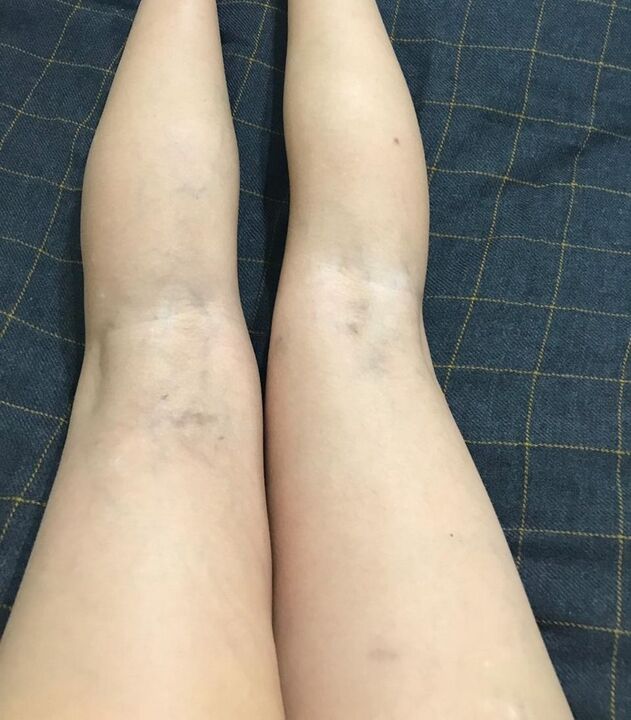 Manifestations de varices dans les jambes.