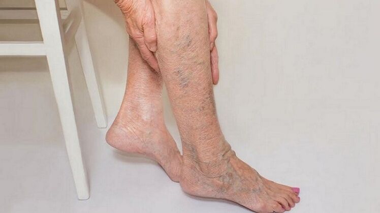 varices dans les jambes