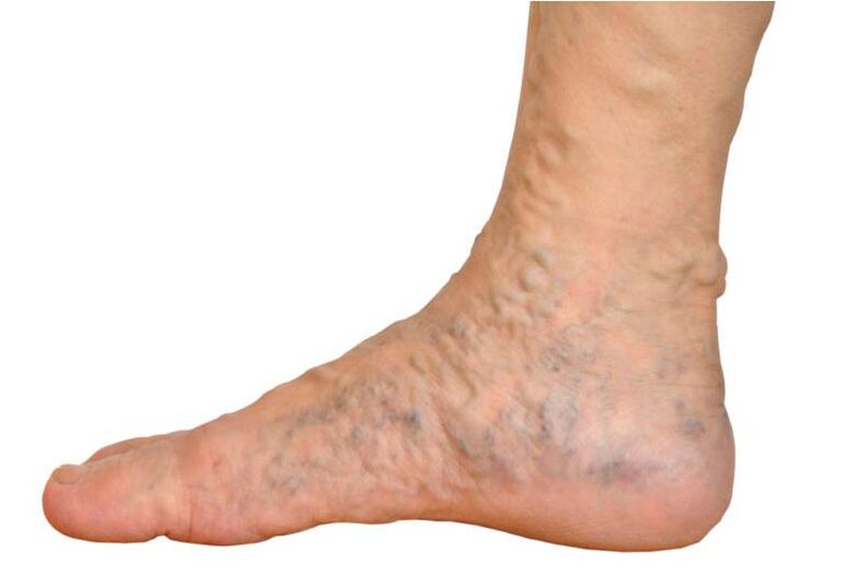 Varices dans la jambe.