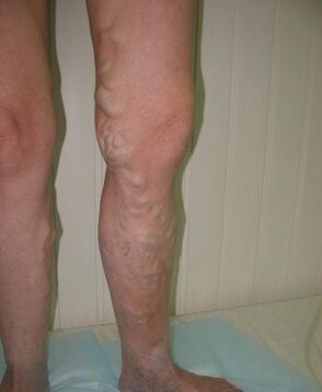 Veines saillantes dans les jambes dues à des varices.