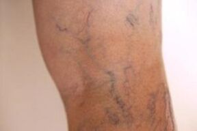 varices dans les jambes